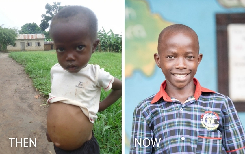 then photo of young malnourished african toddler and now photo of teenager african boy healthy and smiling